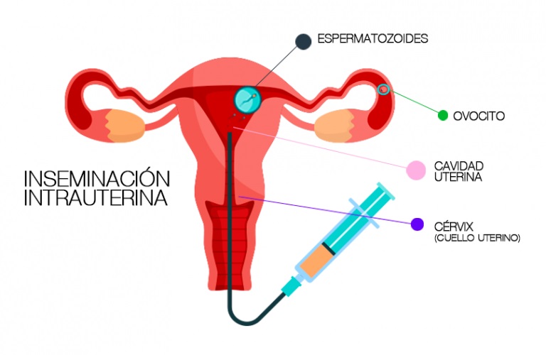 Todo lo que debes saber sobre la inseminación intrauterina